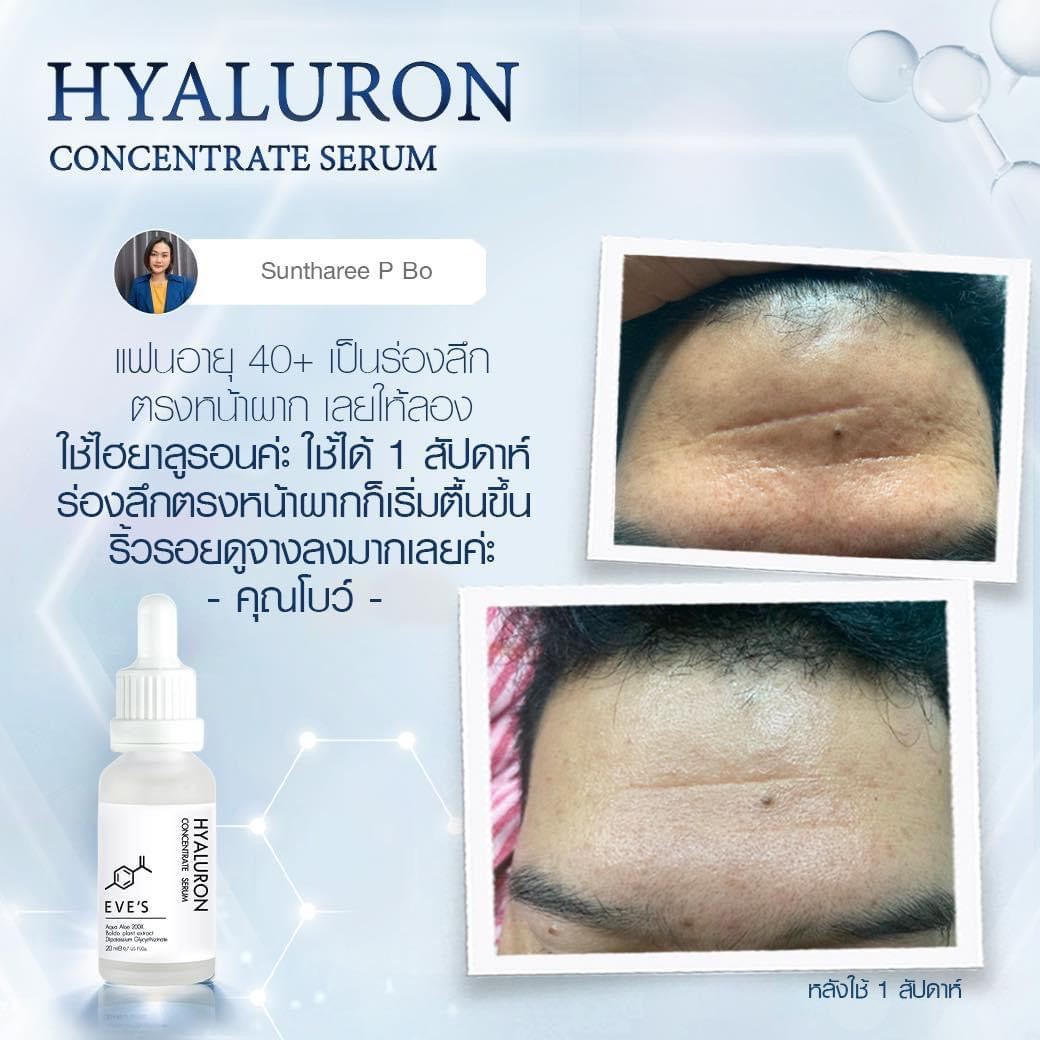 HYALURON CONCENTRATE SERUM ไฮยาลูรอน คอนเซ็นเทรท เซรั่ม เติมเต็มความชุ่มชื้นให้ผิว ริ้วรอยดูตื้นขึ้น HYALURON CONCENTRATE SERUM