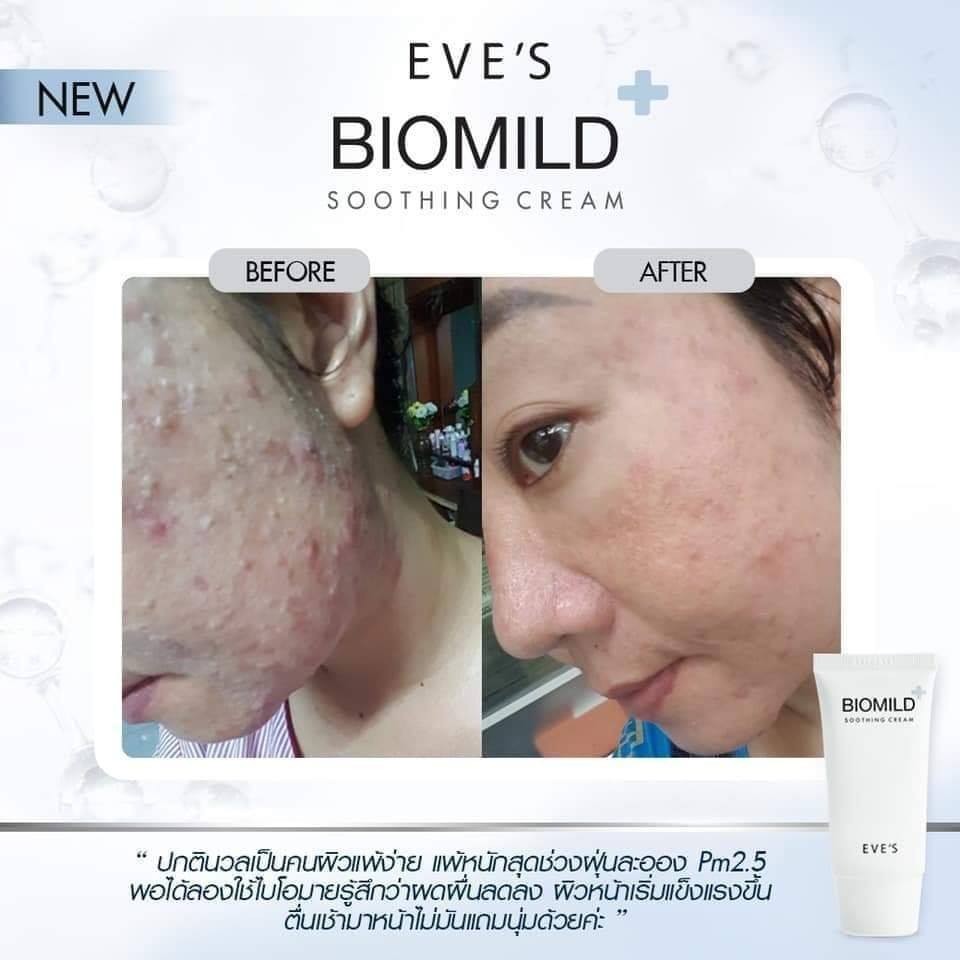 BIOMILD SOOTHING CREAM ไบโอมายด์ ลดสิว ผดผื่น ช่วยลดการระคายเคือง บรรเทาอาการแพ้แสบและคัน