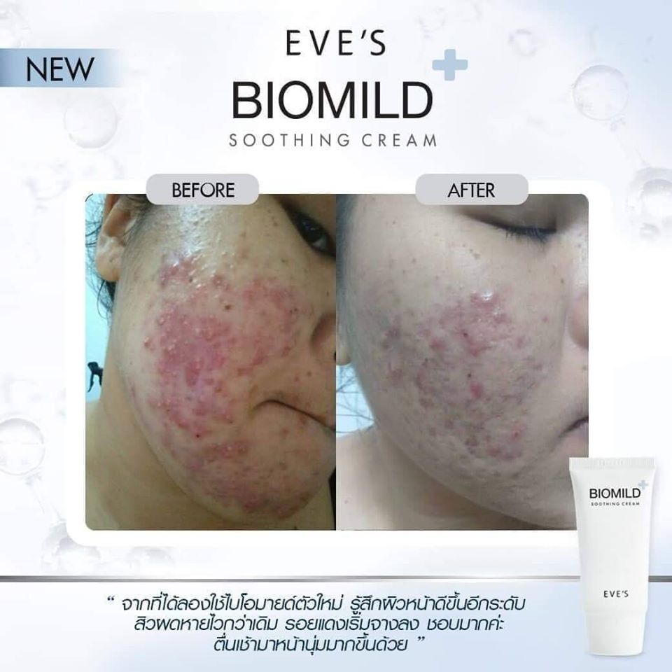 BIOMILD SOOTHING CREAM ไบโอมายด์ ลดสิว ผดผื่น ช่วยลดการระคายเคือง บรรเทาอาการแพ้แสบและคัน