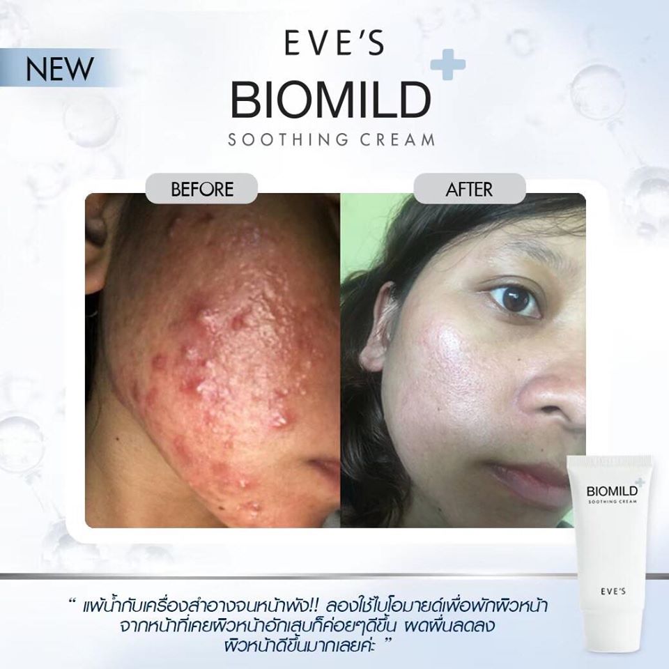 BIOMILD SOOTHING CREAM ไบโอมายด์ ลดสิว ผดผื่น ช่วยลดการระคายเคือง บรรเทาอาการแพ้แสบและคัน