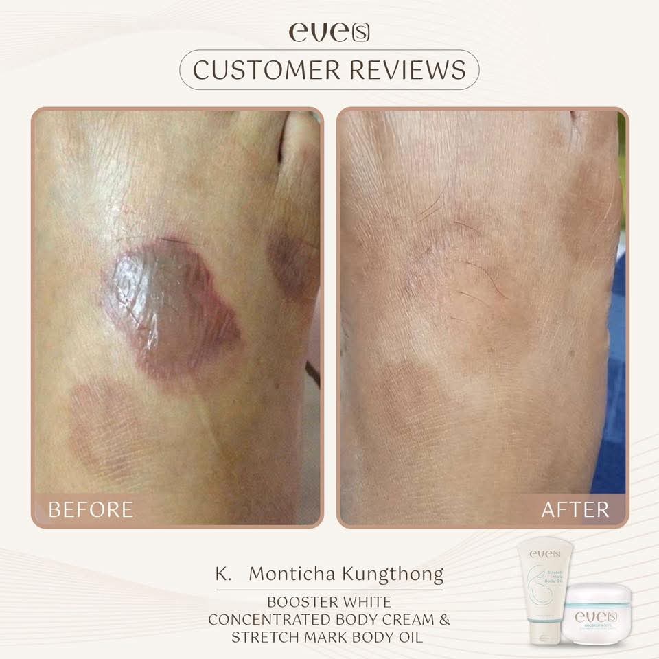 ชุดบำรุงผิวคุณแม่ 1 - 1 อีฟส์ออย / 2 บูสเตอร์ฟ้า